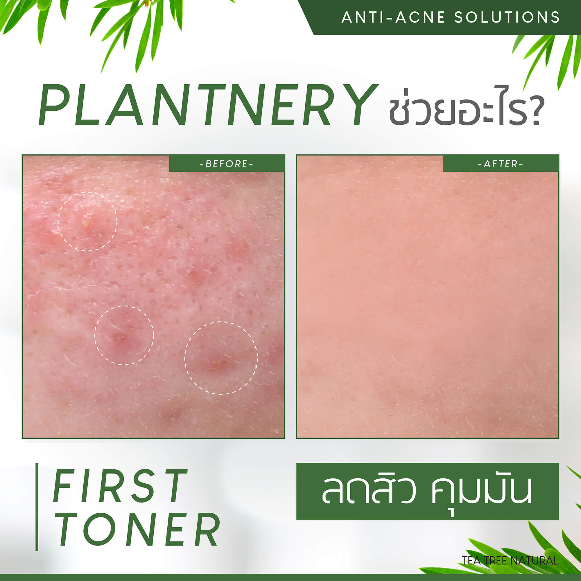 Plantnery Tea Tree Day Cream SPF30 PA+++ 50 g    มีคุณสมบัติ  - ลดสิวอักเสบ ละลายสิวอุดตัน  - ฟื้นบำรุงรอยแผลใหม่จากสิว  - ลดความมันและควบคุมความมันระหว่างวันได้ยาวนานถึง 8 ชั่วโมง  - ป้องกันการเกิดฝ้าแดด และจุดด่างดำ  - ลดโอกาสเกิดสิวอุดตันได้อย่างมีประสิทธิภาพ (Non-Comedogenic)  - ลดการสะสมของเชื้อ P.Acne ต้นเหตุของการเกิดสิว